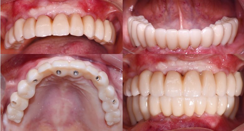 Final Full-Zirconia Prosthesis