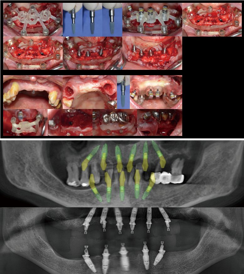 All-on-X Surgery Process with Stackable Guide