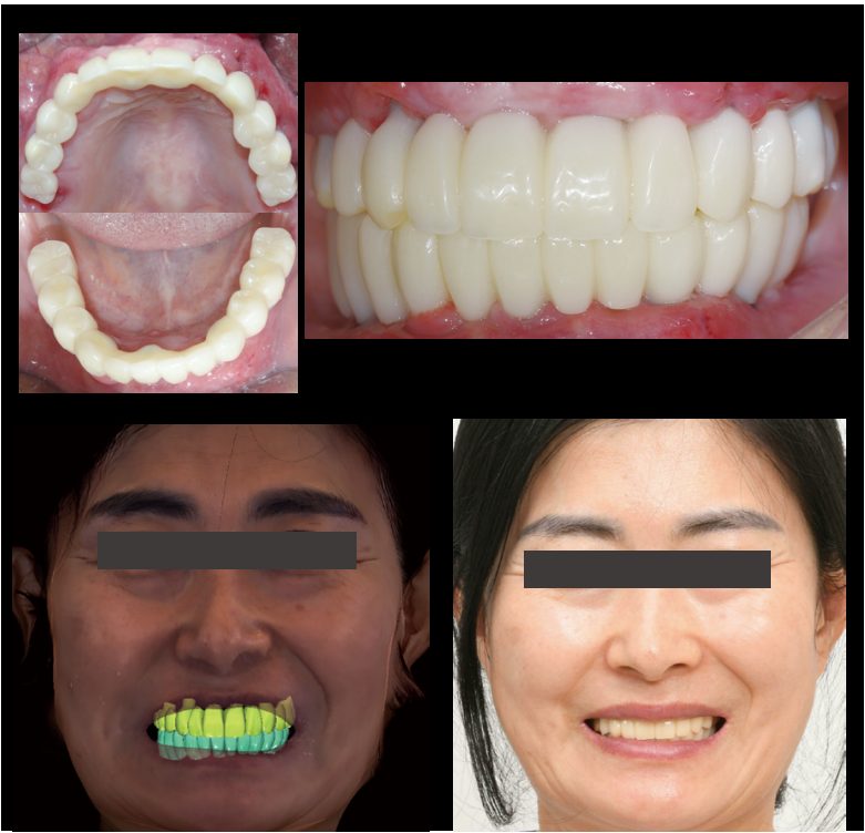 Provisional prosthesis and Smile