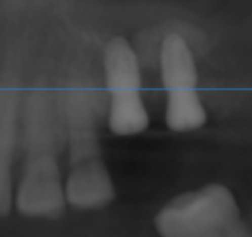 上顎洞底挙上術のX線画像