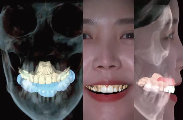 CBCT・口腔内スキャン・顔貌スキャンを統合した3D設計